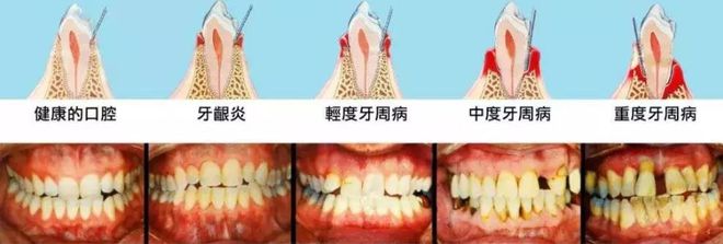 牙周病与脑卒中风险关联揭秘，潜在健康威胁不容忽视